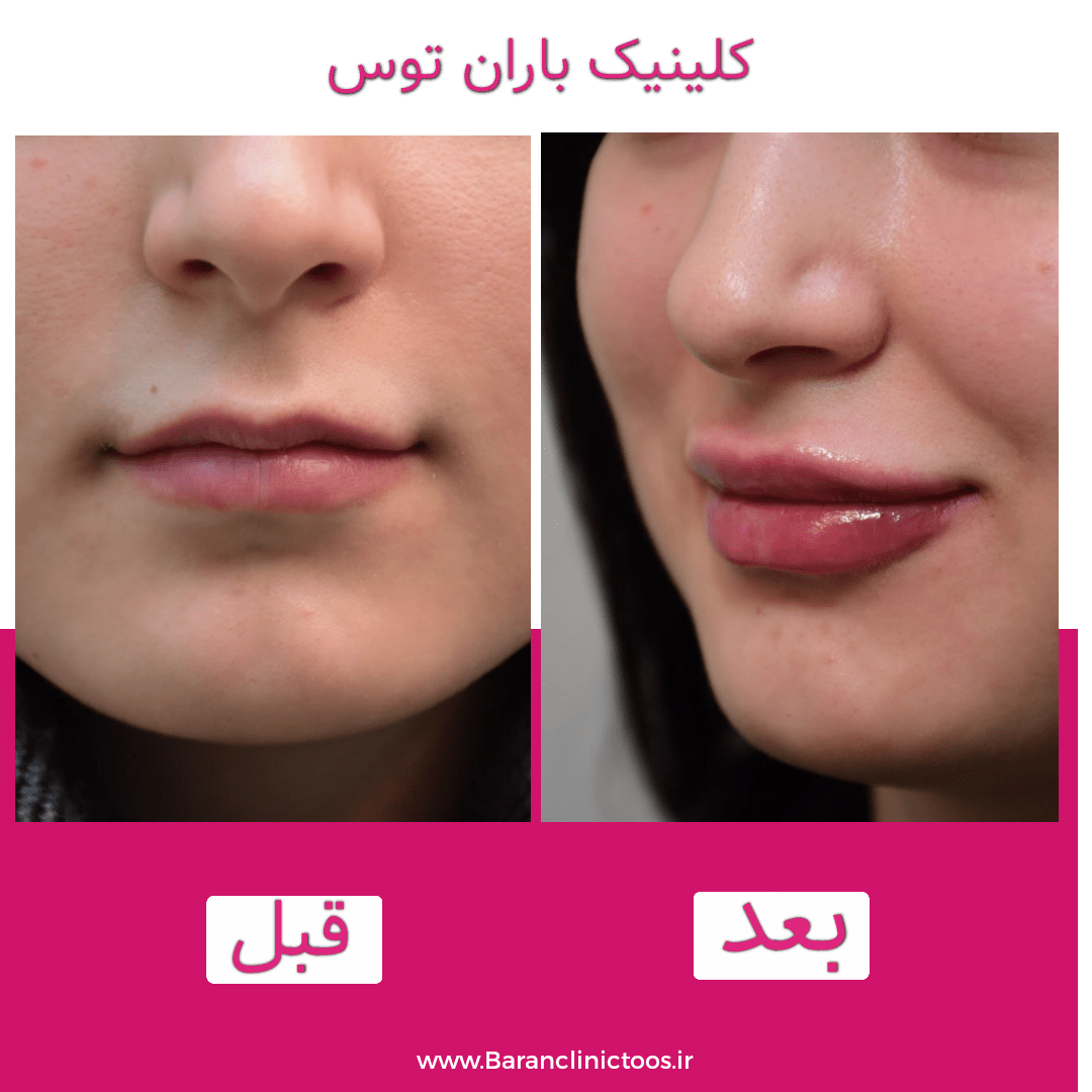 قبل و بعد فیلر لب